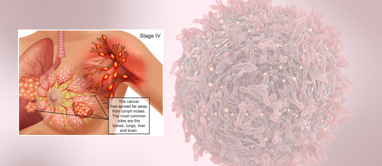 Cancer Doctor In Rajasthan