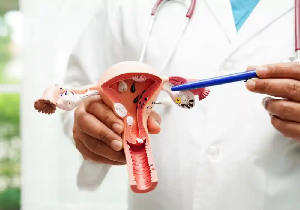 Cervical cancer anatomical model showing cervix and tumor location