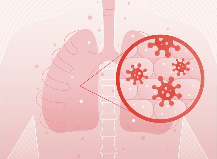 lung-cancer lung-cancer
